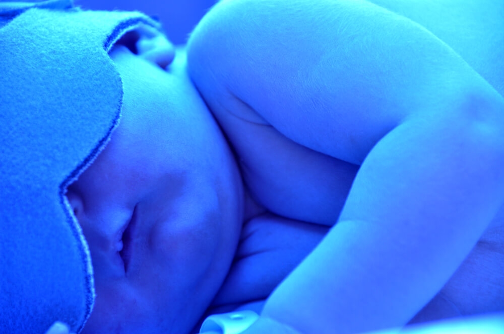 Does My Child Have a Kernicterus Claim?