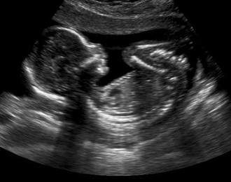 Can Cerebral Palsy be Prevented at Birth?
