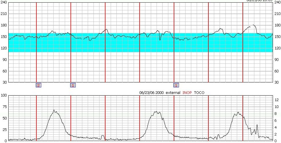 Why Fetal Monitoring is Essential to Prevent Birth Injury
