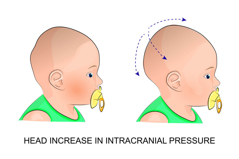 Abnormal Head Shape in Newborns