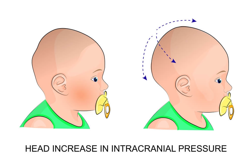 Abnormal Head Shape in Newborns