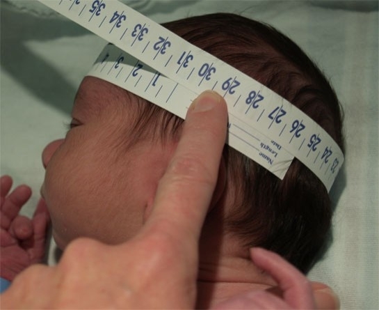 Why the Size of Your Baby’s Head Matters for Cerebral Palsy Risk