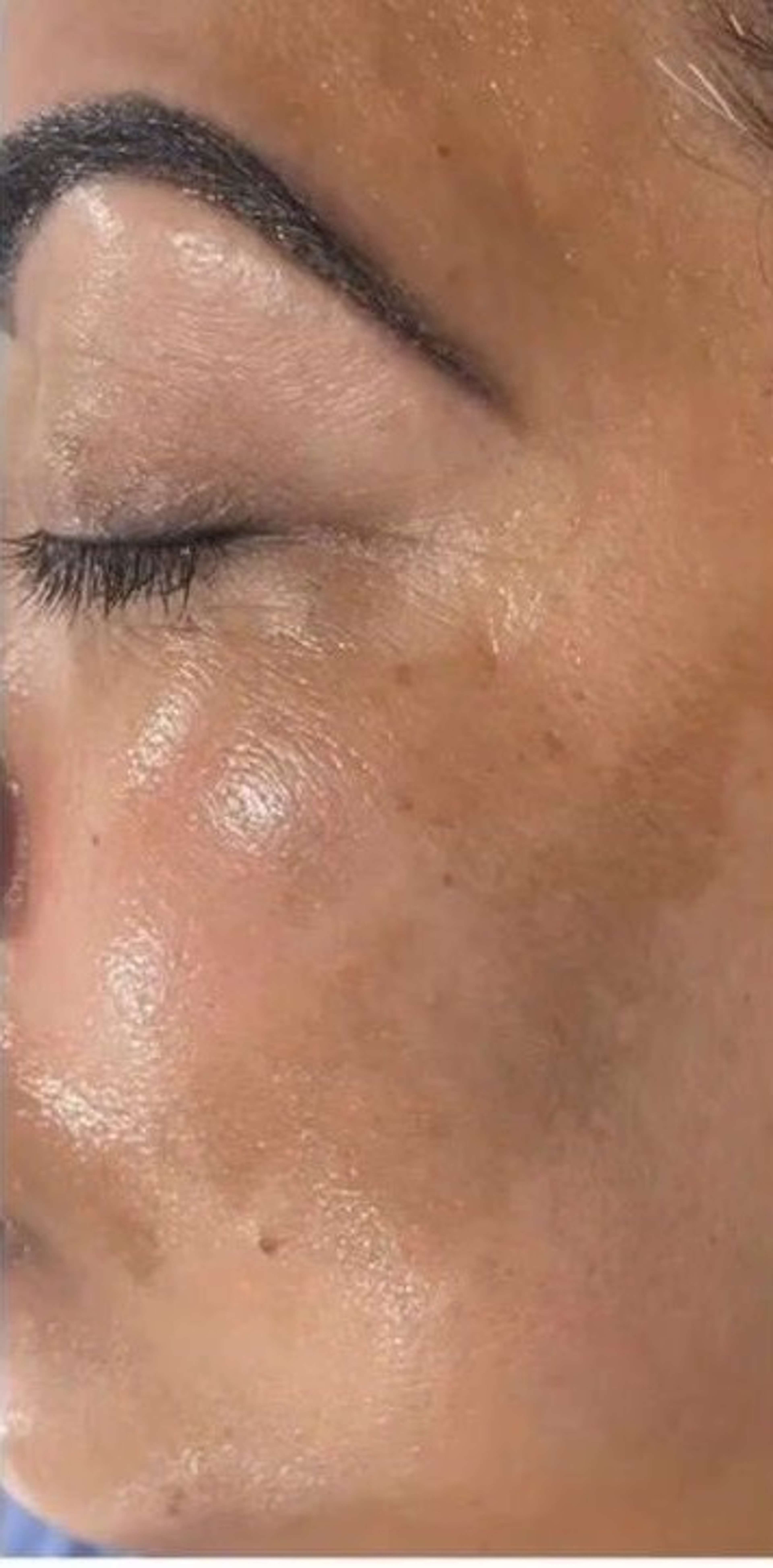 Korean Glass Skin before – Snowvique Wellness Studio Donnybrook Melbourne