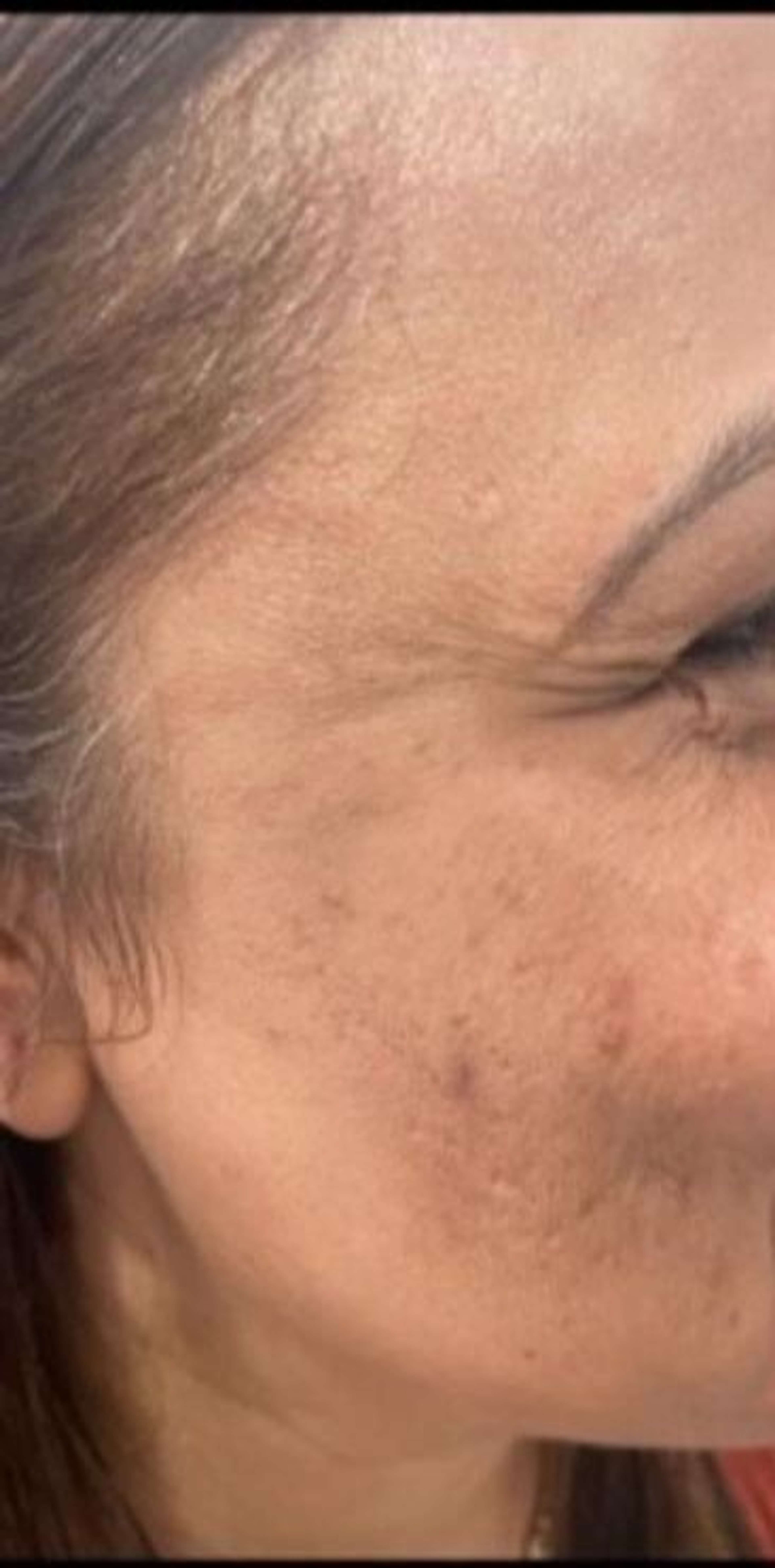 Acne Repair before – Snowvique Wellness Studio Donnybrook Melbourne
