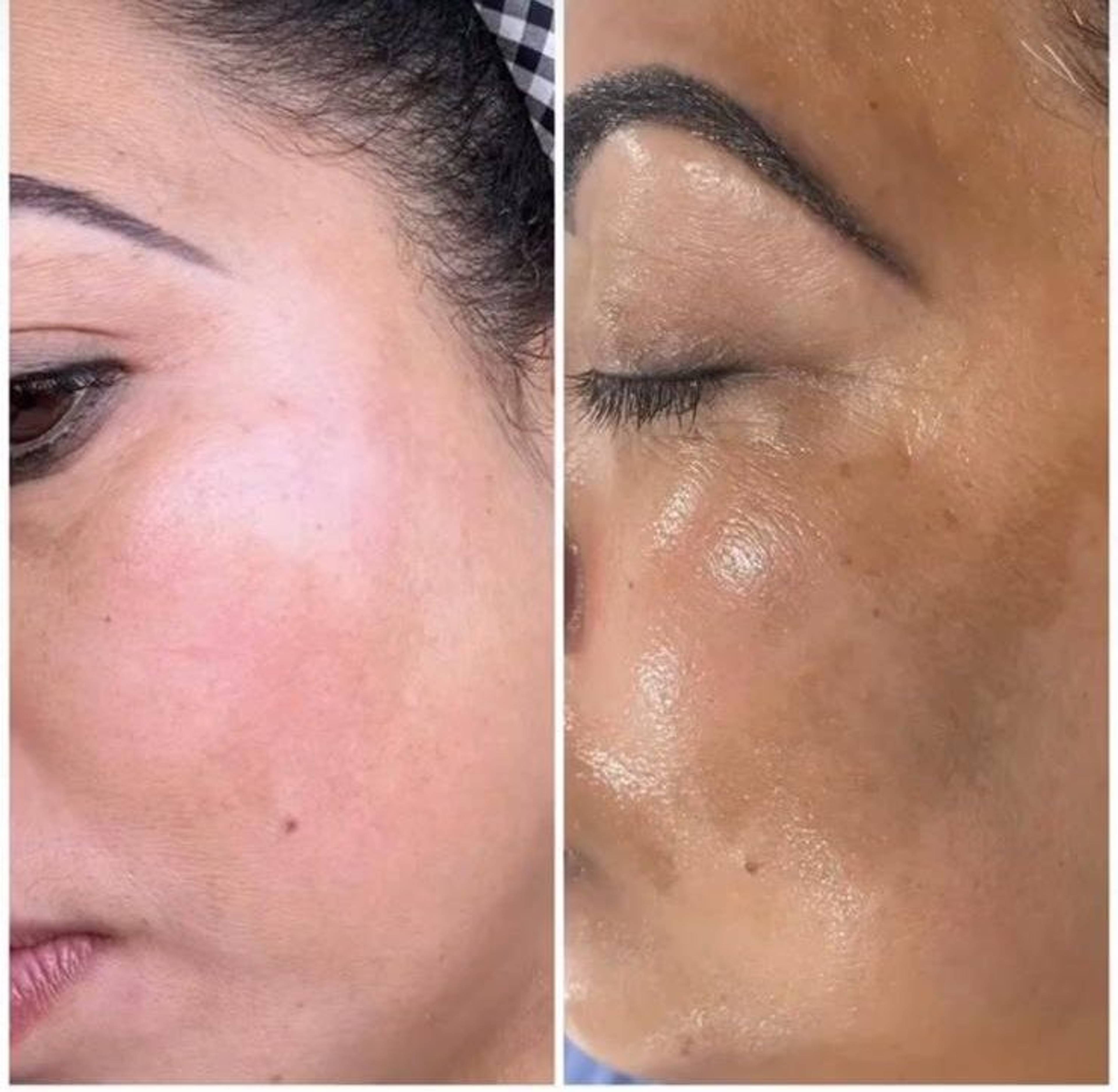Skin Brightening Treatment