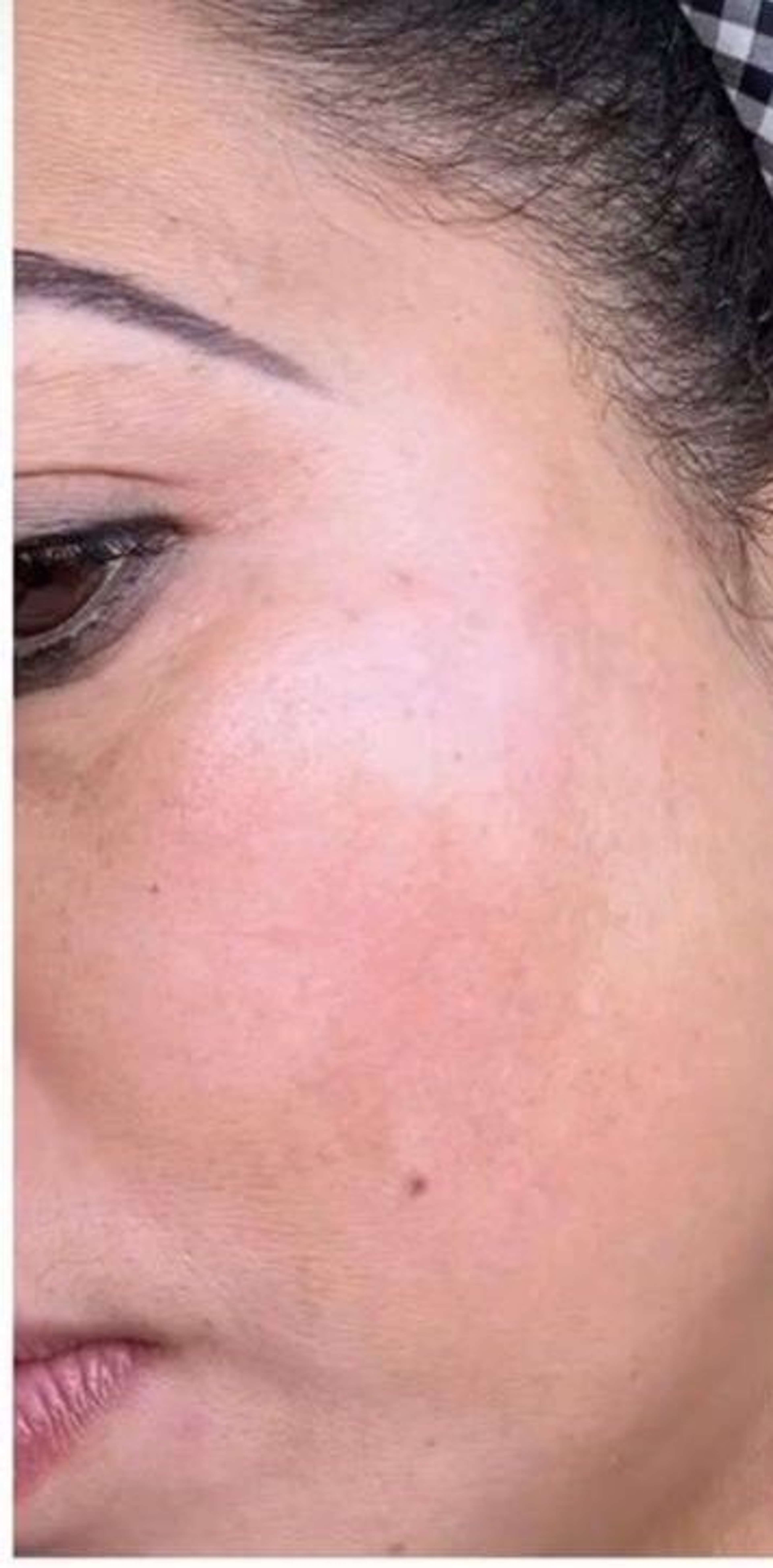 Korean Glass Skin after – Snowvique Wellness Studio Donnybrook Melbourne