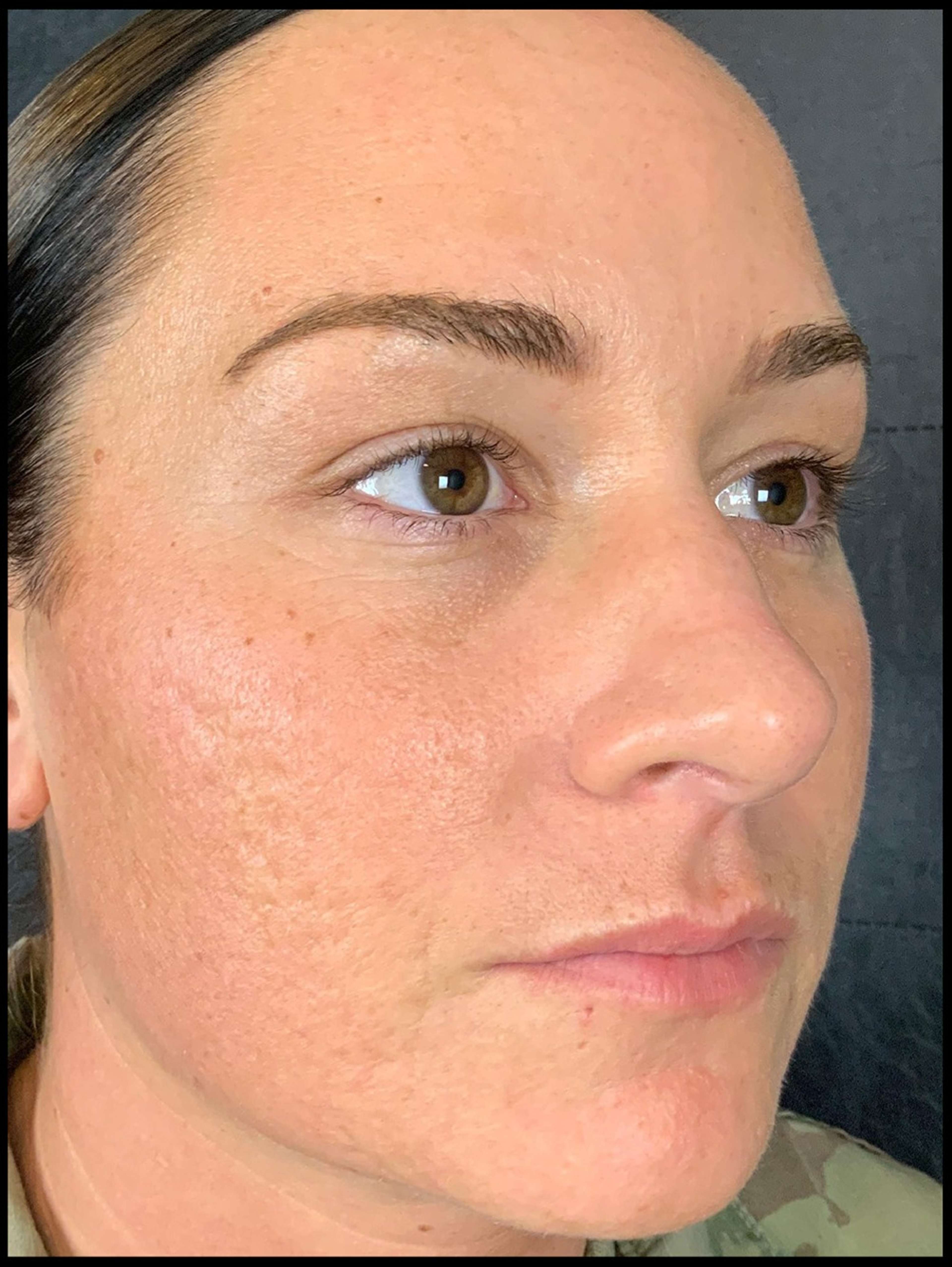 Skin procedures After
