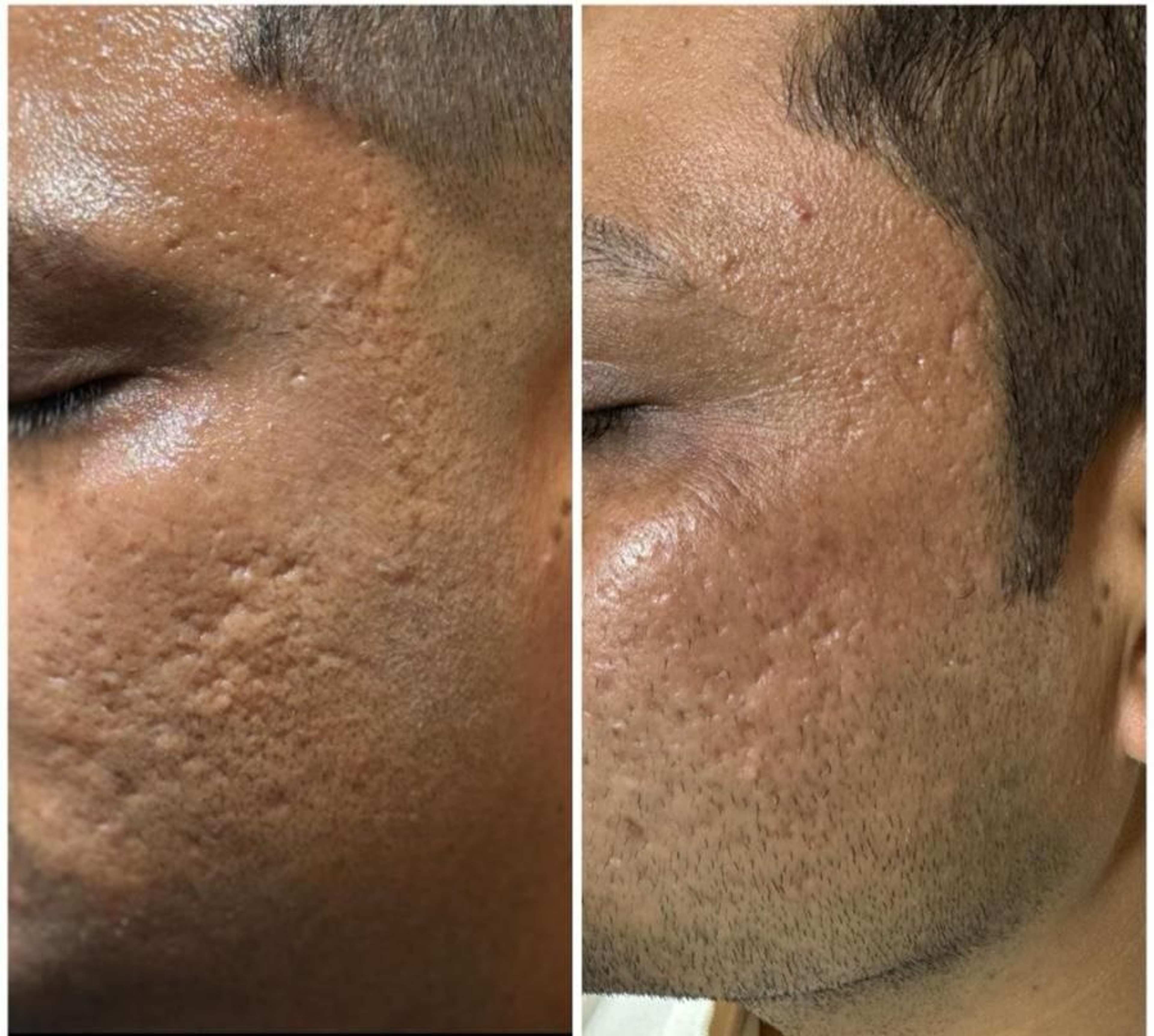 Acne Scar & Textural Revision