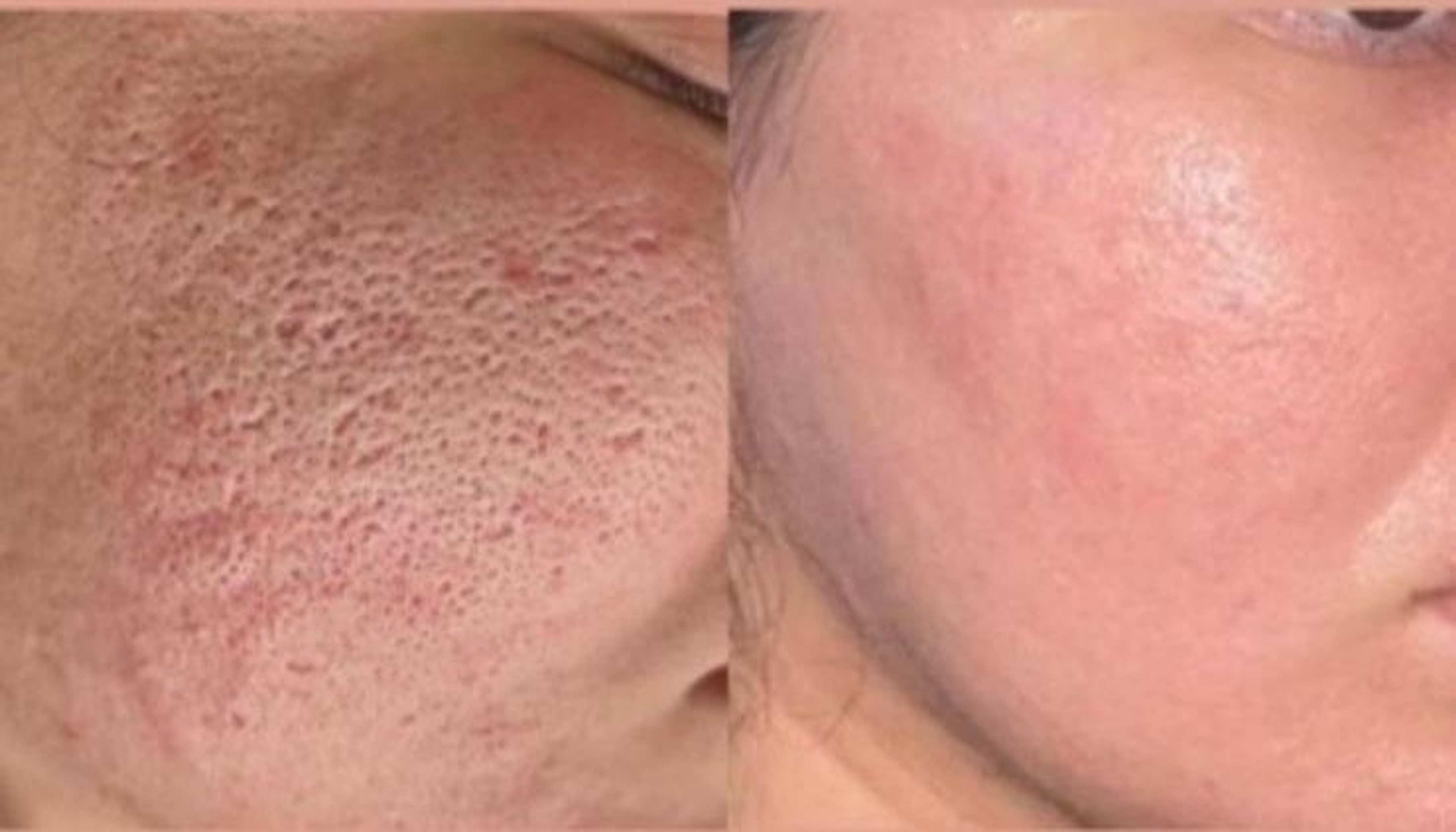 Open Pores & Skin Resurfacing