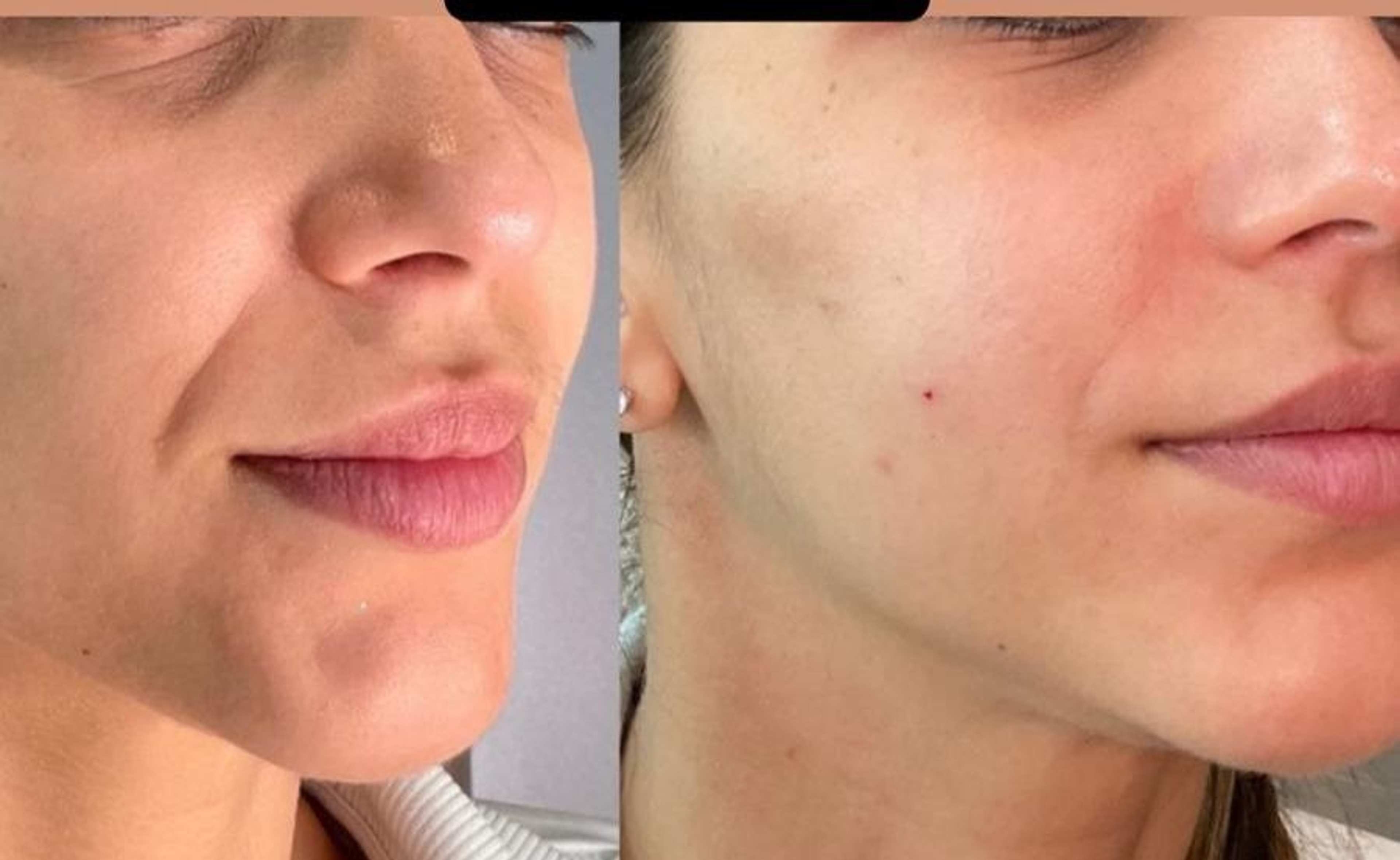 Facial Rejuvenation