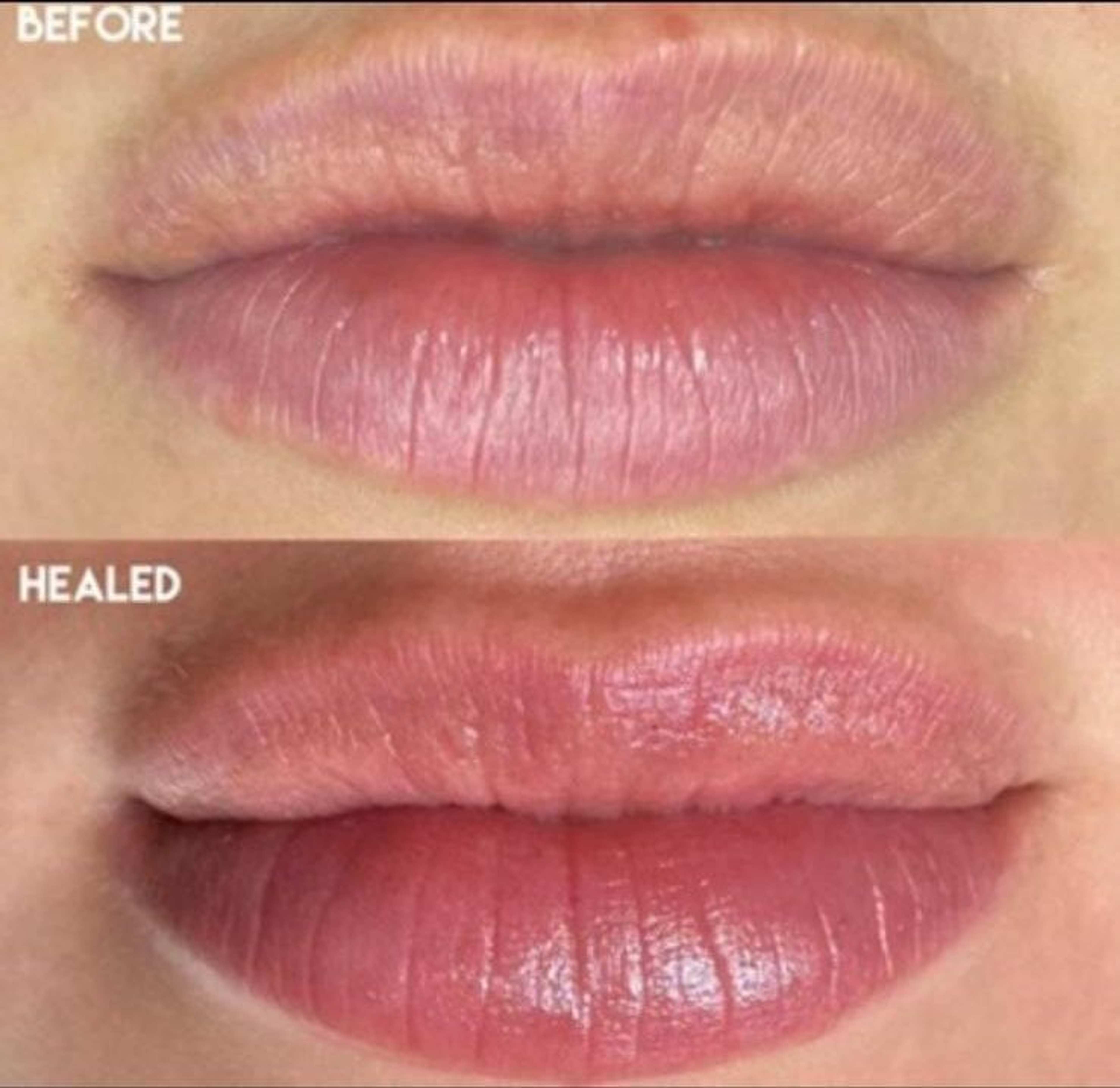 Lip Neutralization & Tinting