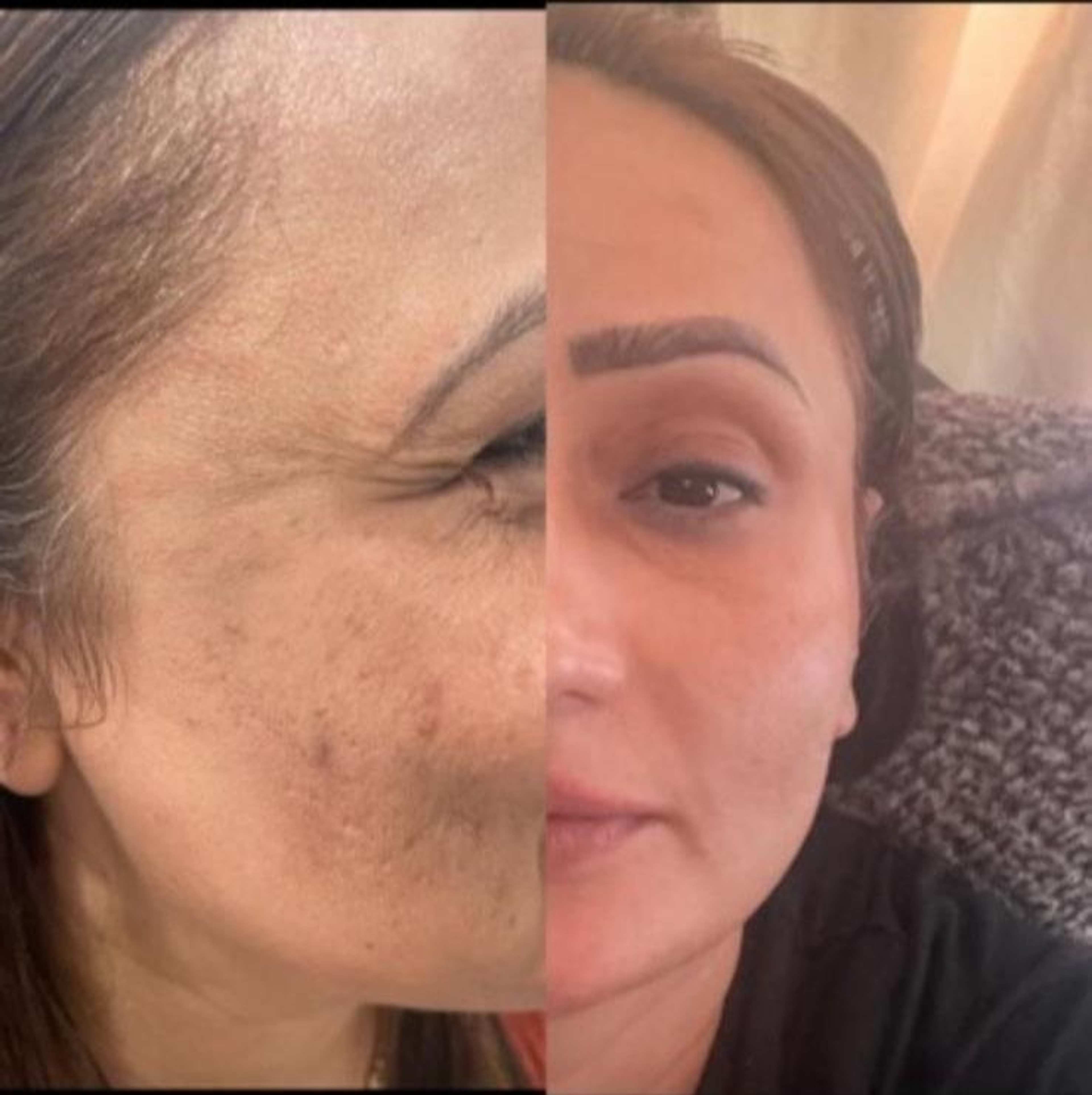 Non-Invasive Facelift
