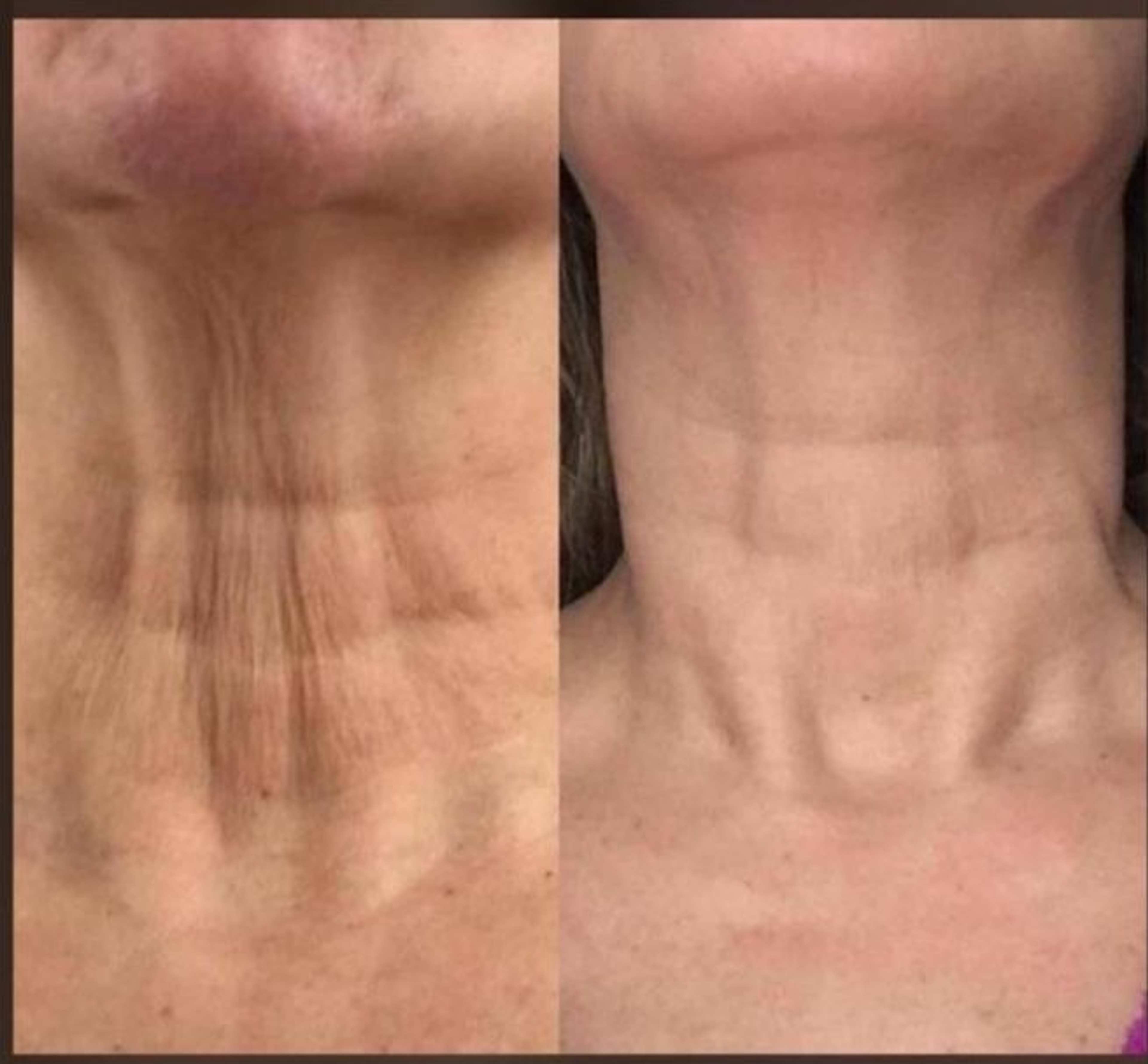 Neck Tightening