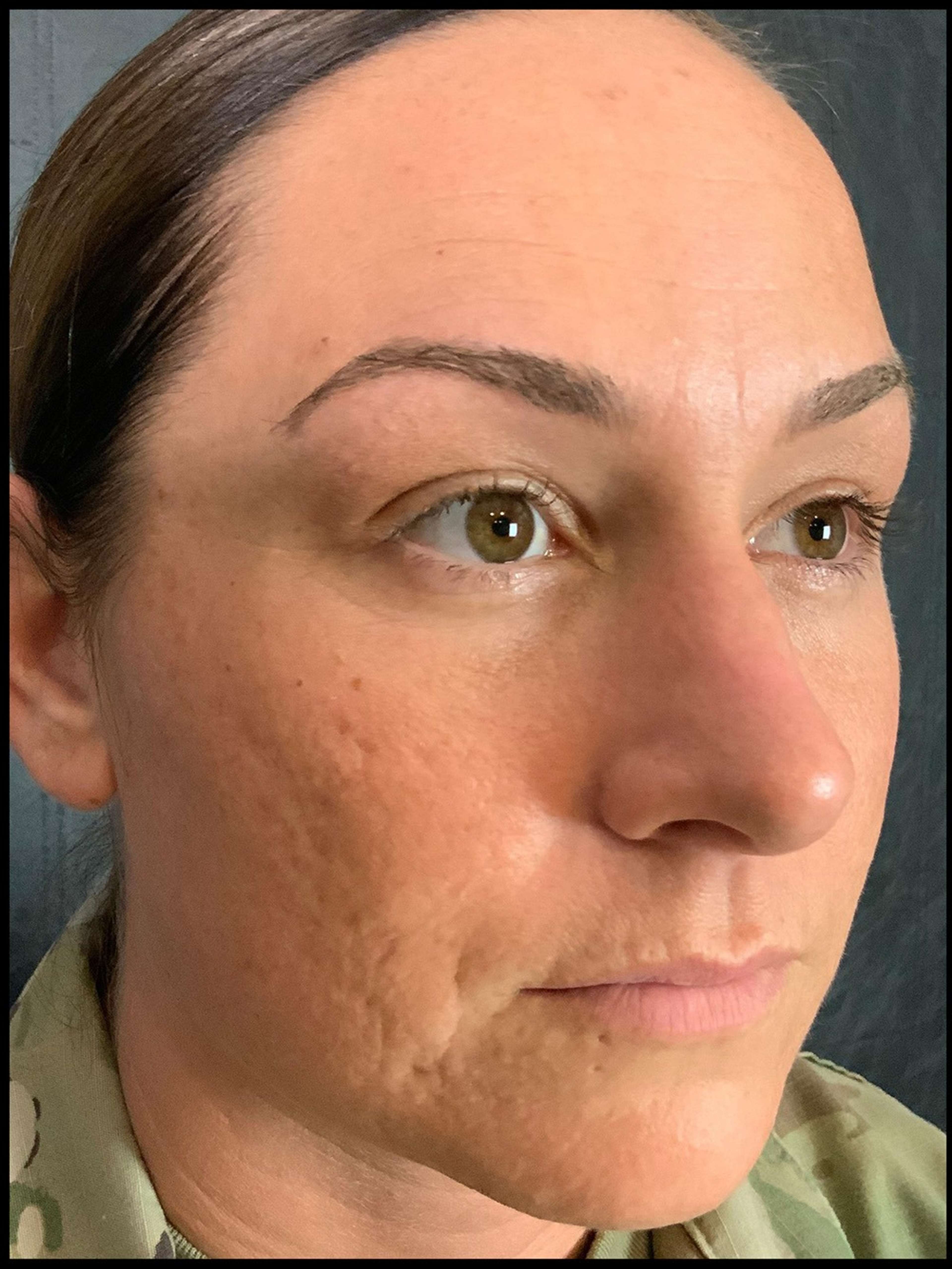 Skin procedures Before