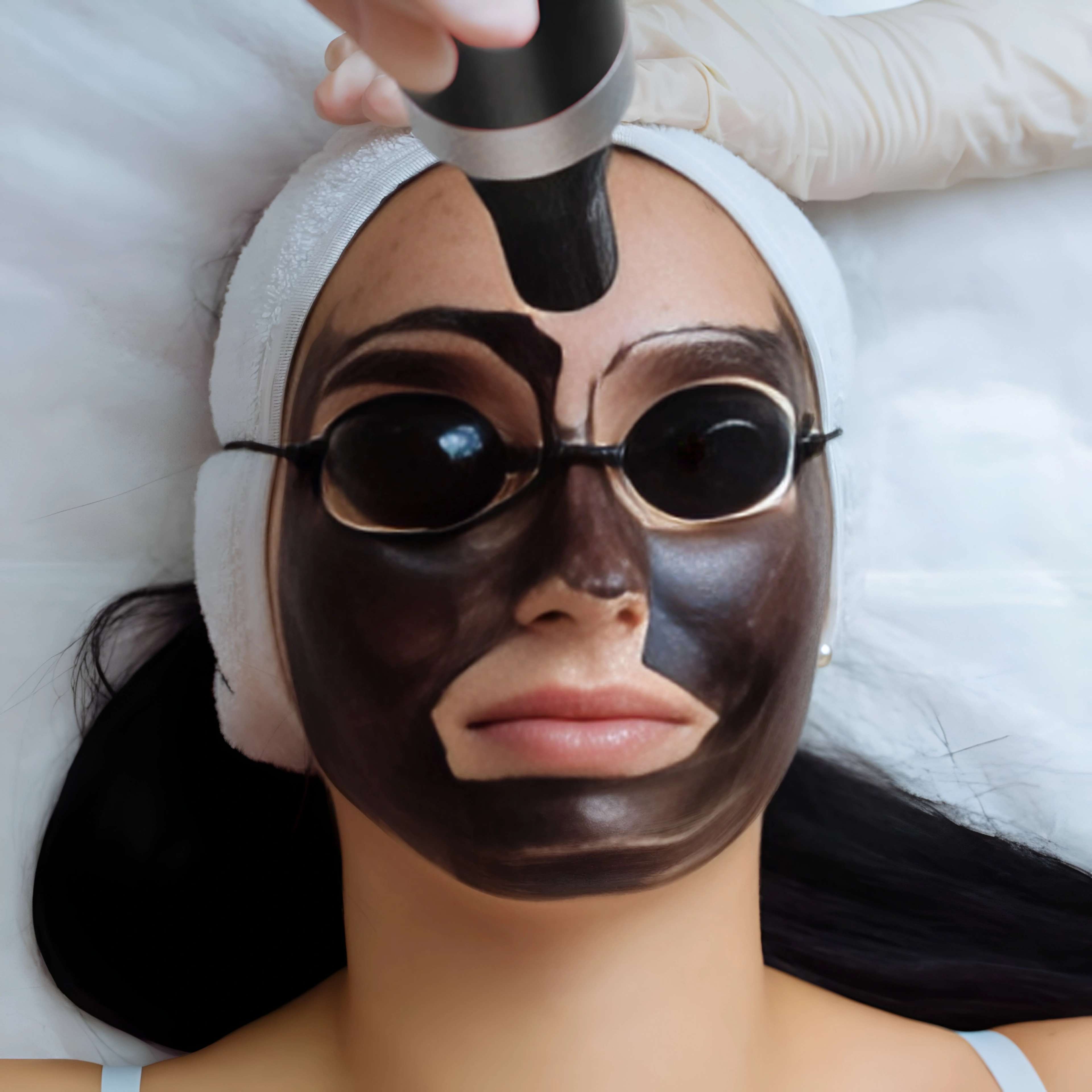 Carbon Laser Facial Procedures in Donnybrook, Melbourne