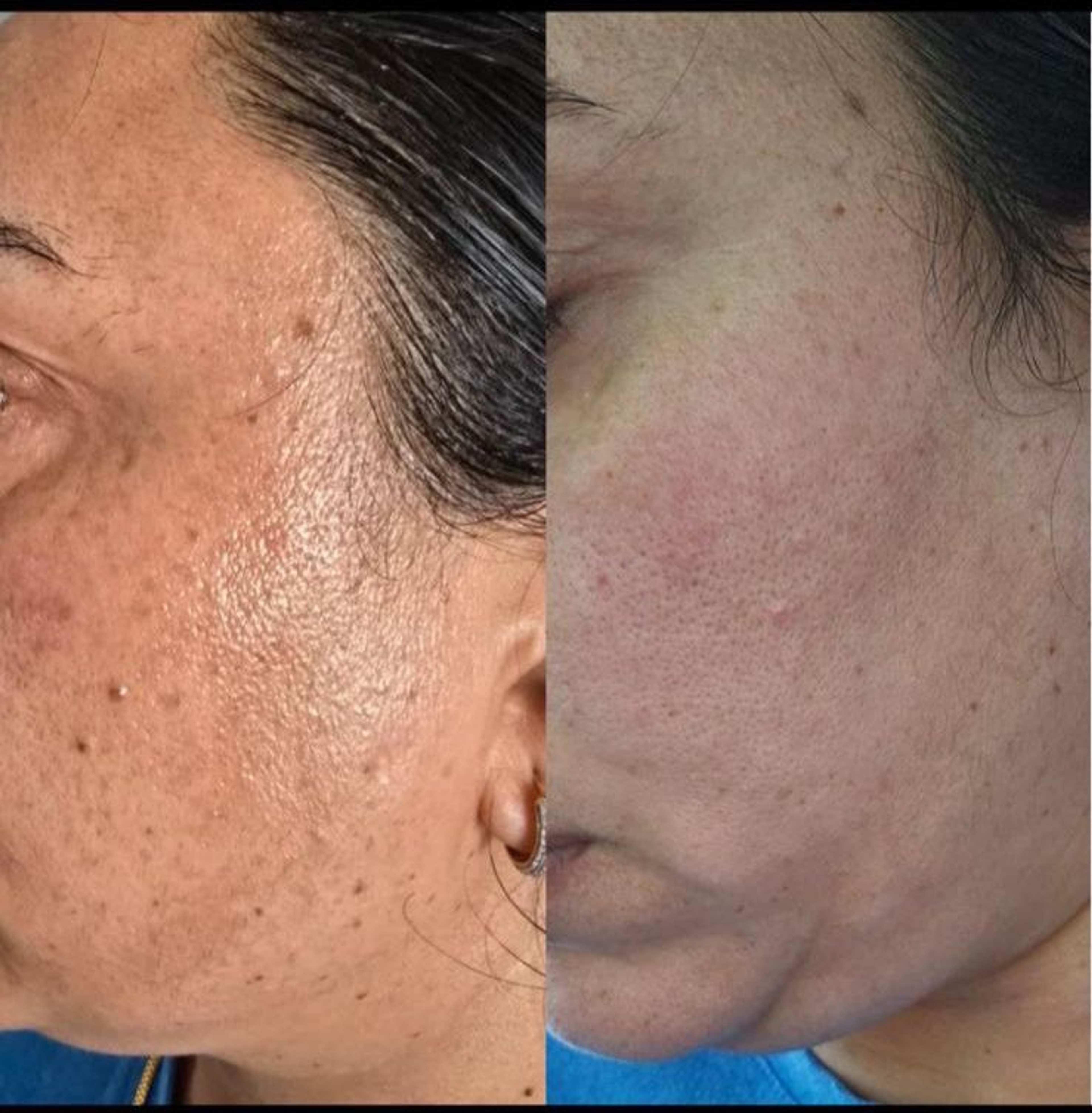 Laser Skin Resurfacing