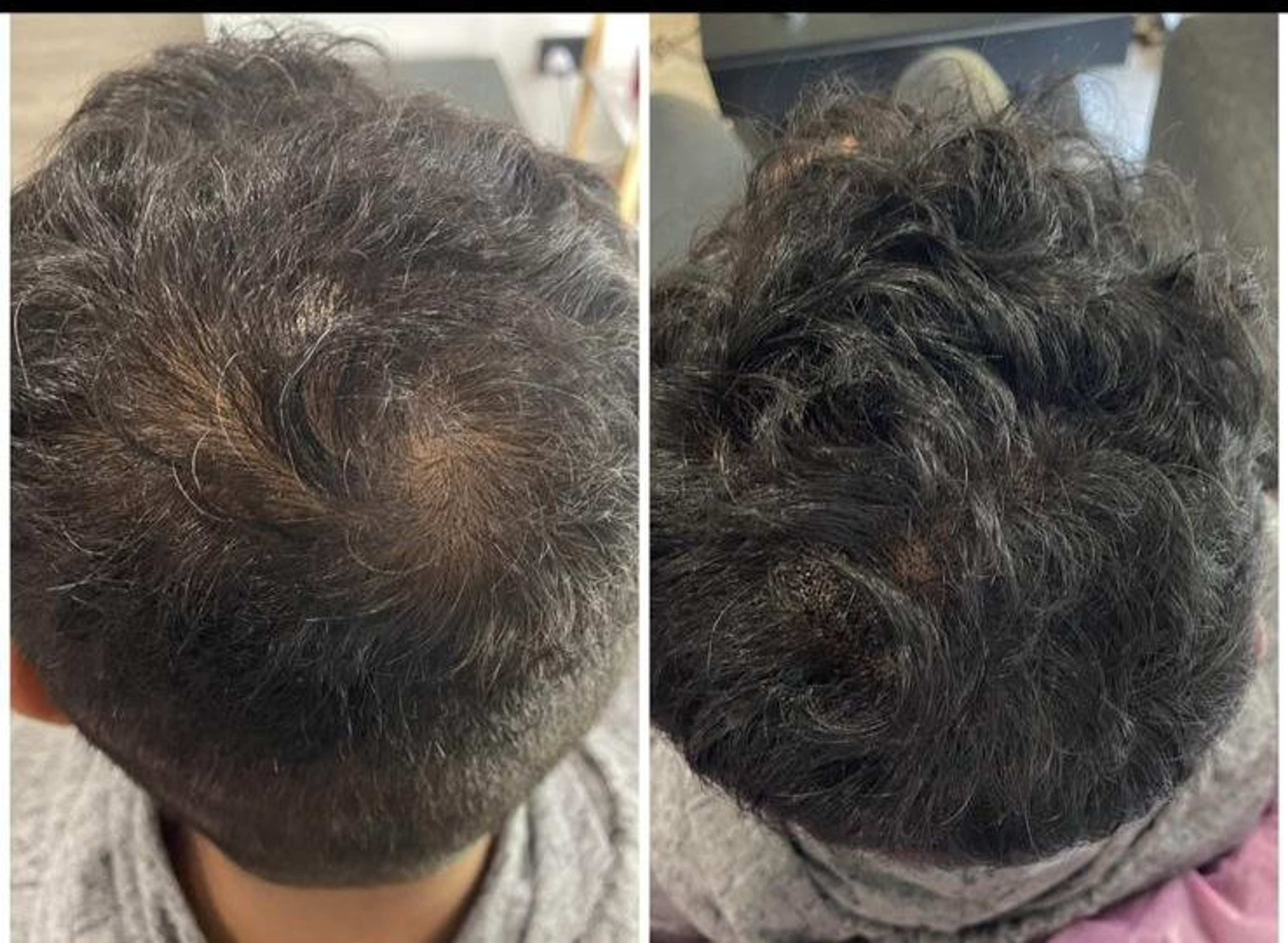 Scalp Micropigmentation