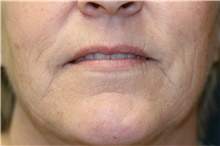 Lips before lip enhancement