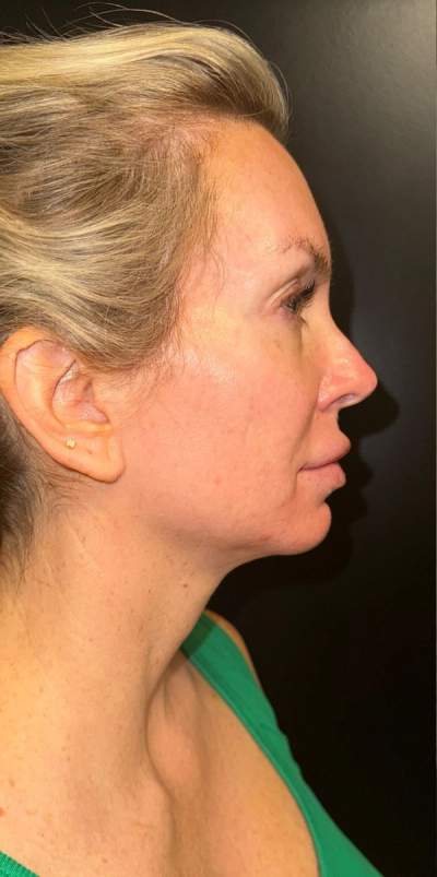 Jawline and neck before Morpheus8