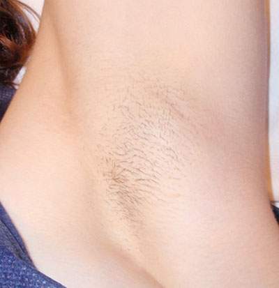 Underarm after 6 laser hair removal sessions