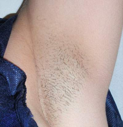Underarm before laser hair removal