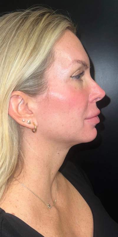 Jawline and neck after 3 Morpheus8 sessions