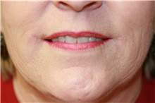Lips immediately after lip enhancement