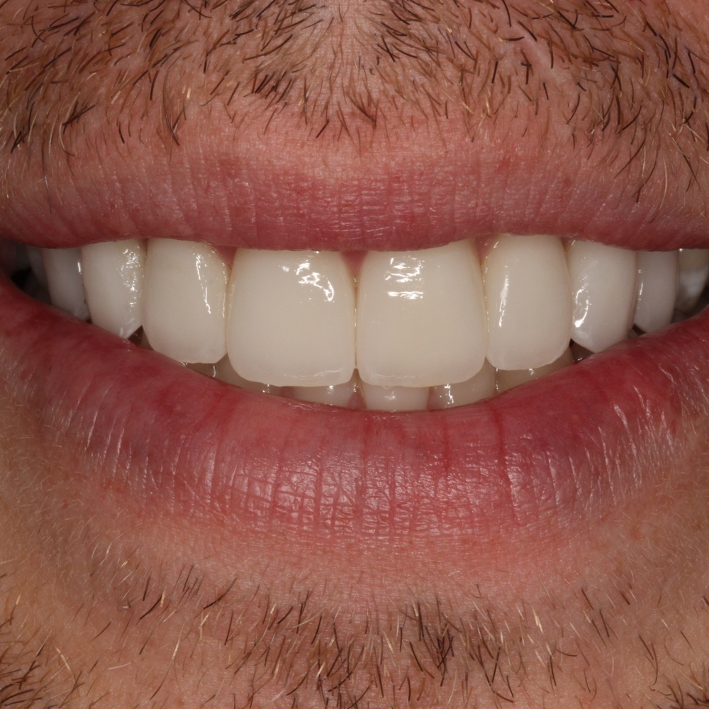 Male 1 - After