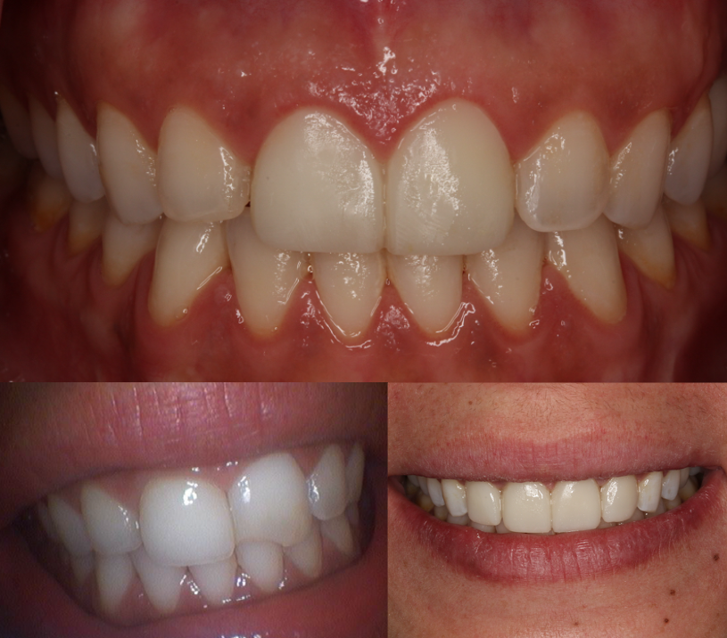 Before and After Veneers by Dr Igor Chikunov