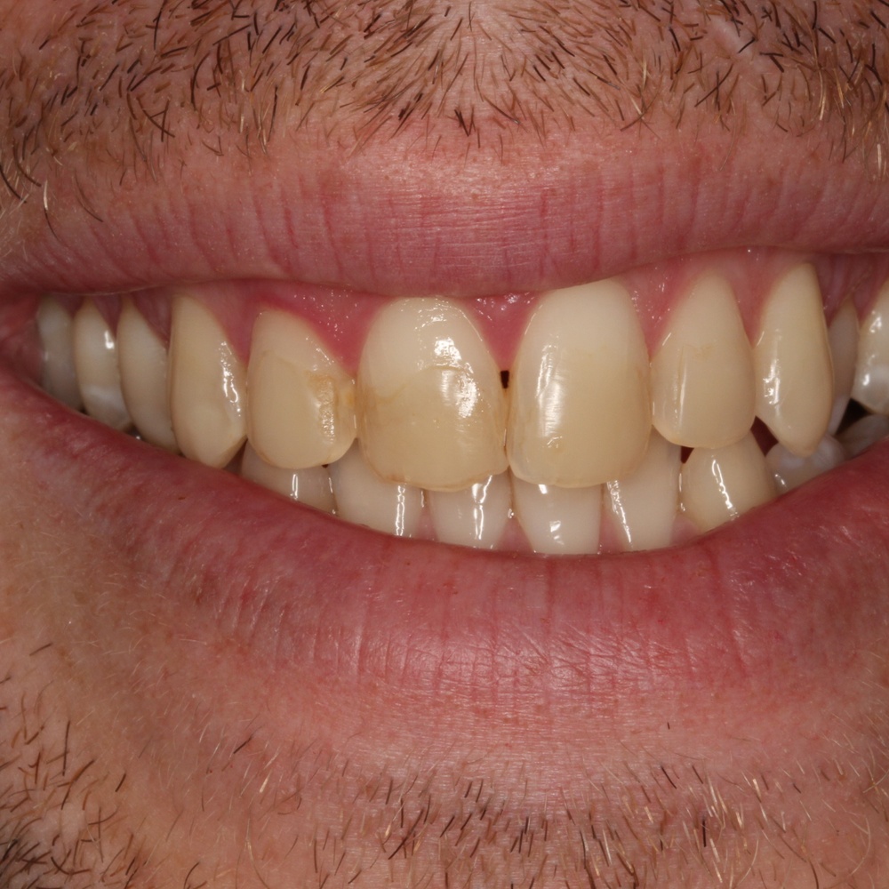Male 1 - Before