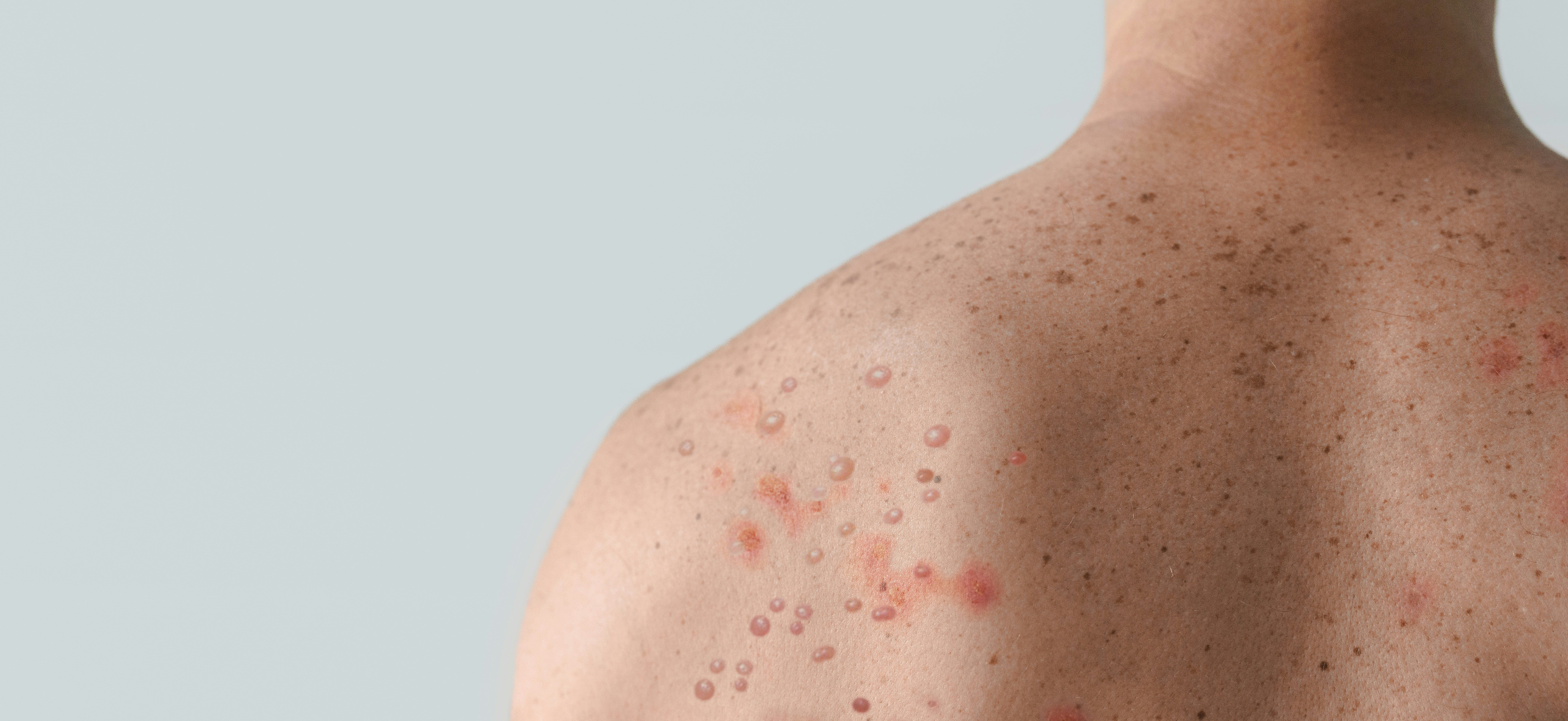 Placer County has identified a measles outbreak of 8 confirmed cases.