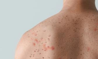 Placer County Confirms Eight Measles Cases in Ongoing Outbreak