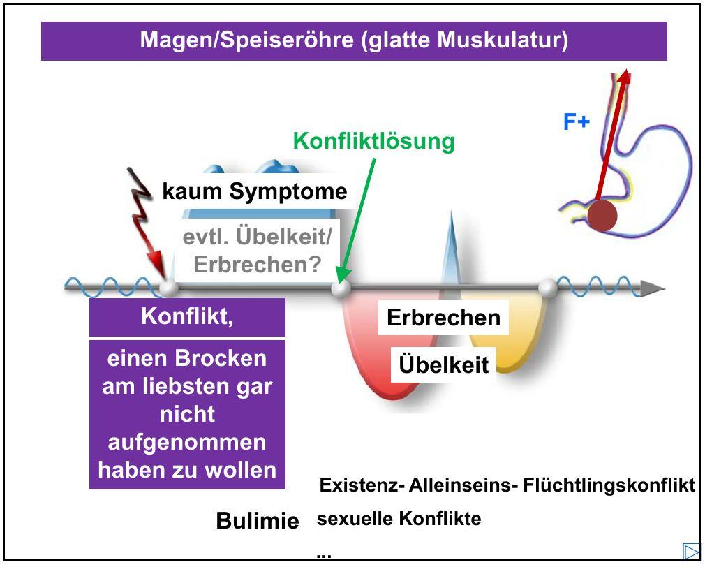 Verlaufskurve zu Magen und Speiseröhre mit Übelkeit und Erbrechen in der Lösungsphase