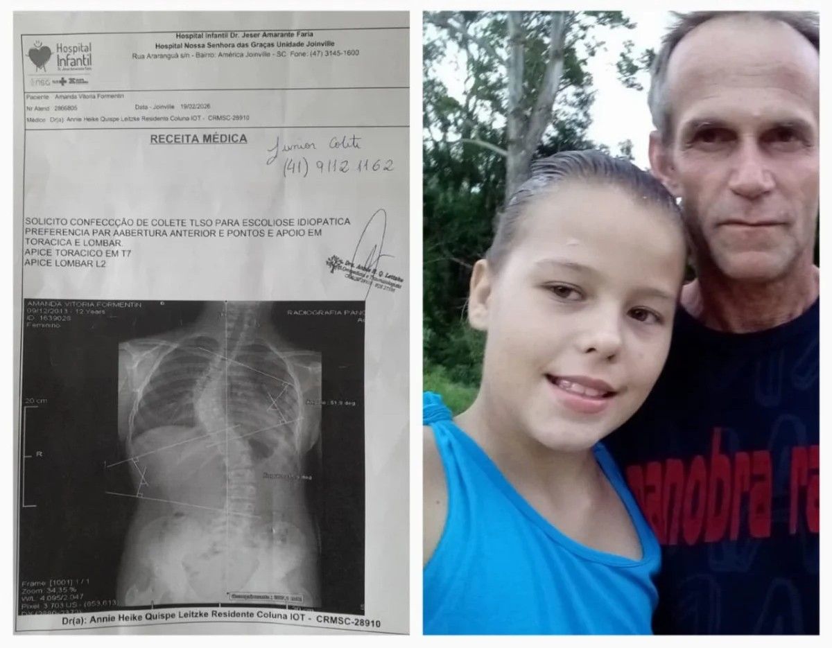 Menina de Vitor Meireles precisa de tratamento urgente contra escoliose severa
