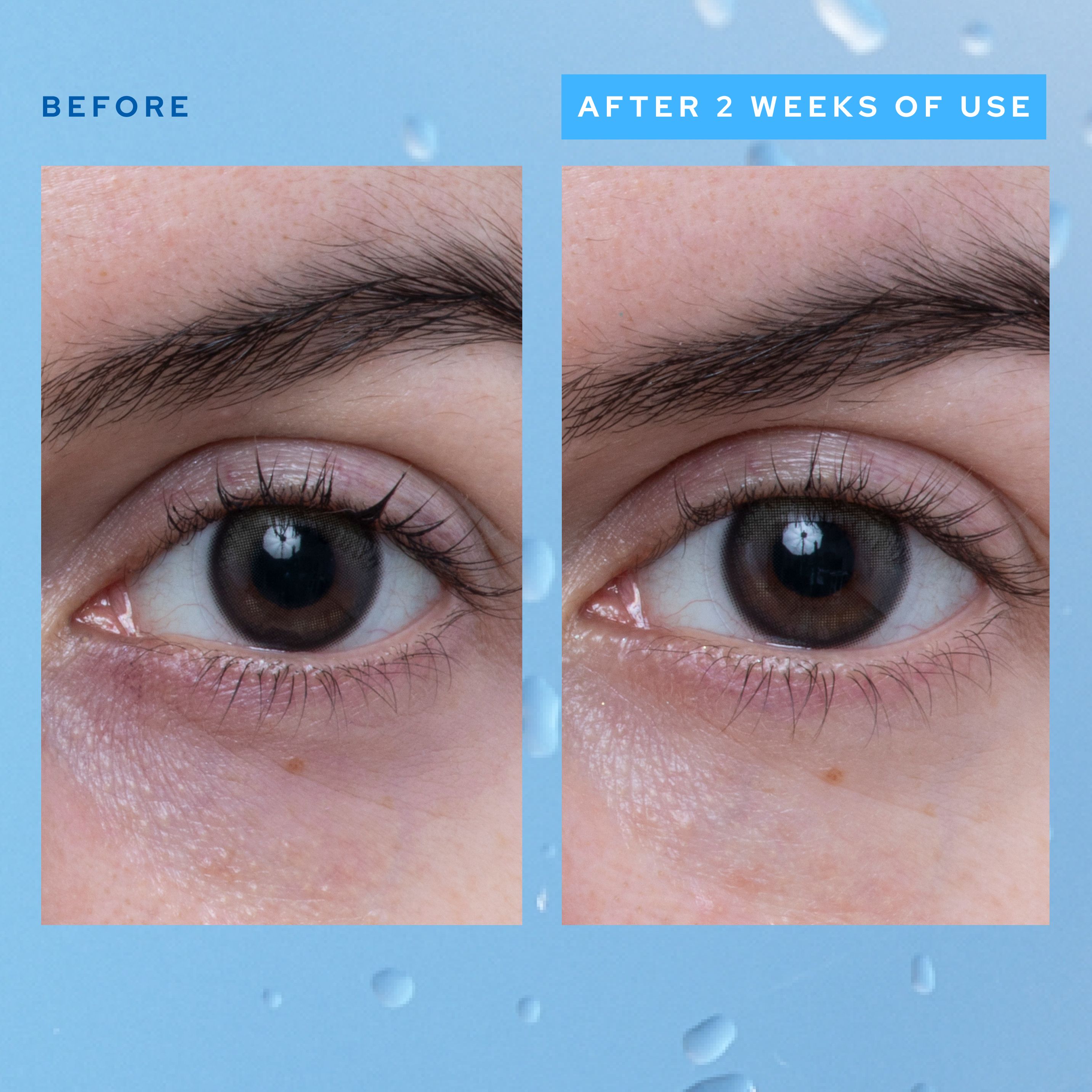 A split image showing "before" and "after" effects of belif Aqua Bomb Eye Gel on the under-eye area. The "before" side shows a close-up of an eye with visible puffiness, while the "after" side shows the same eye with firmer, smoother skin labeled "After 2 weeks of use"