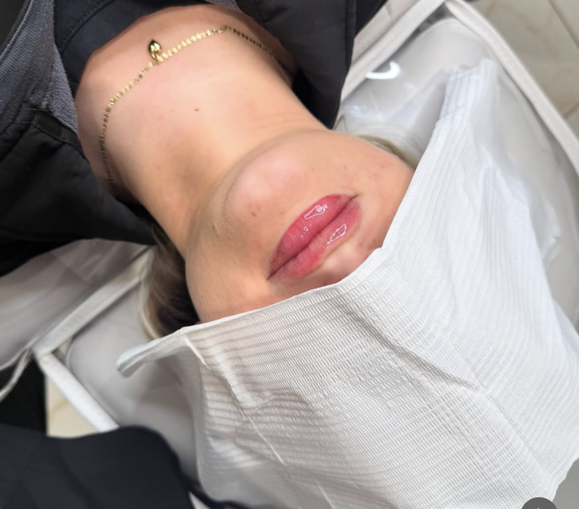 lip filler result