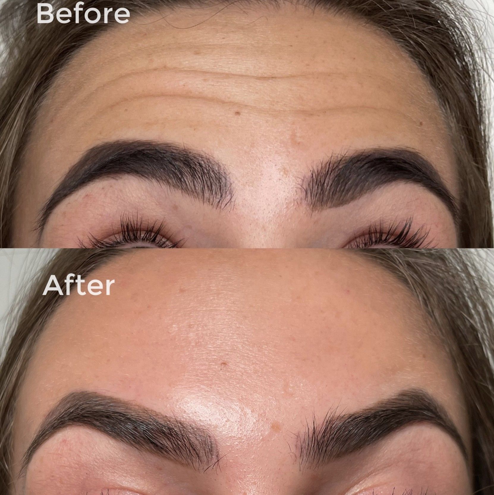 Anti-Wrinkle Treatment