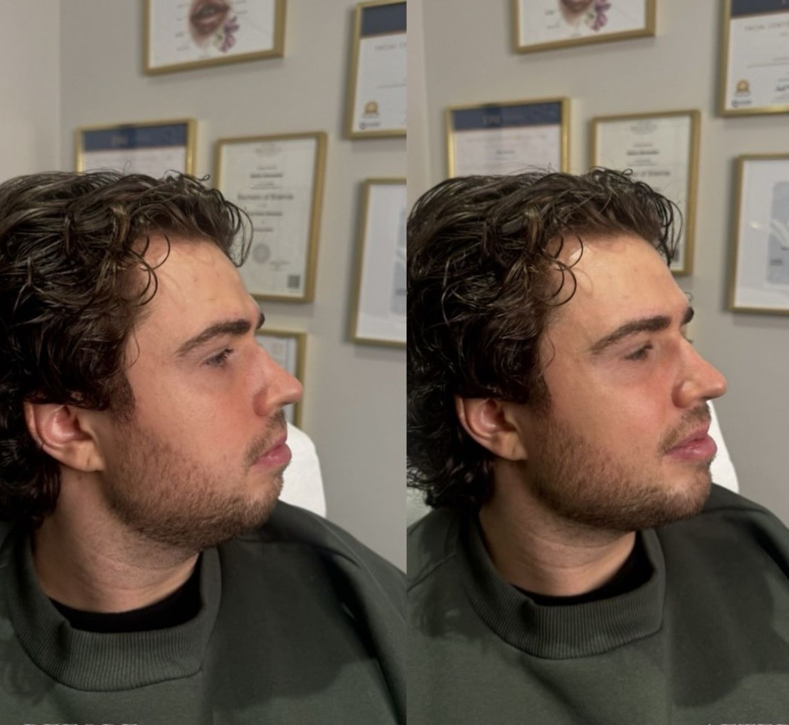 man chin filler
