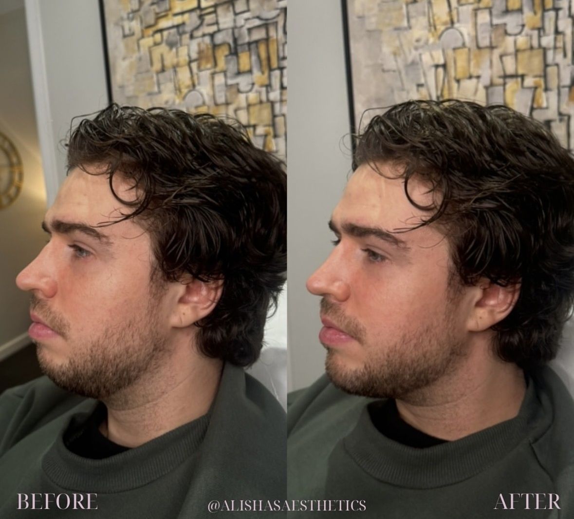 man chin filler before and after