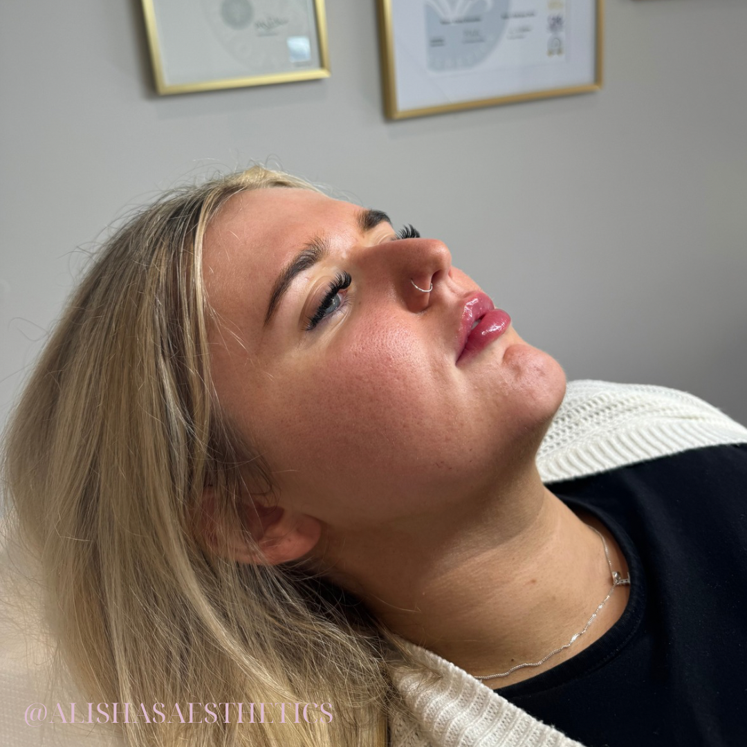 lip filler