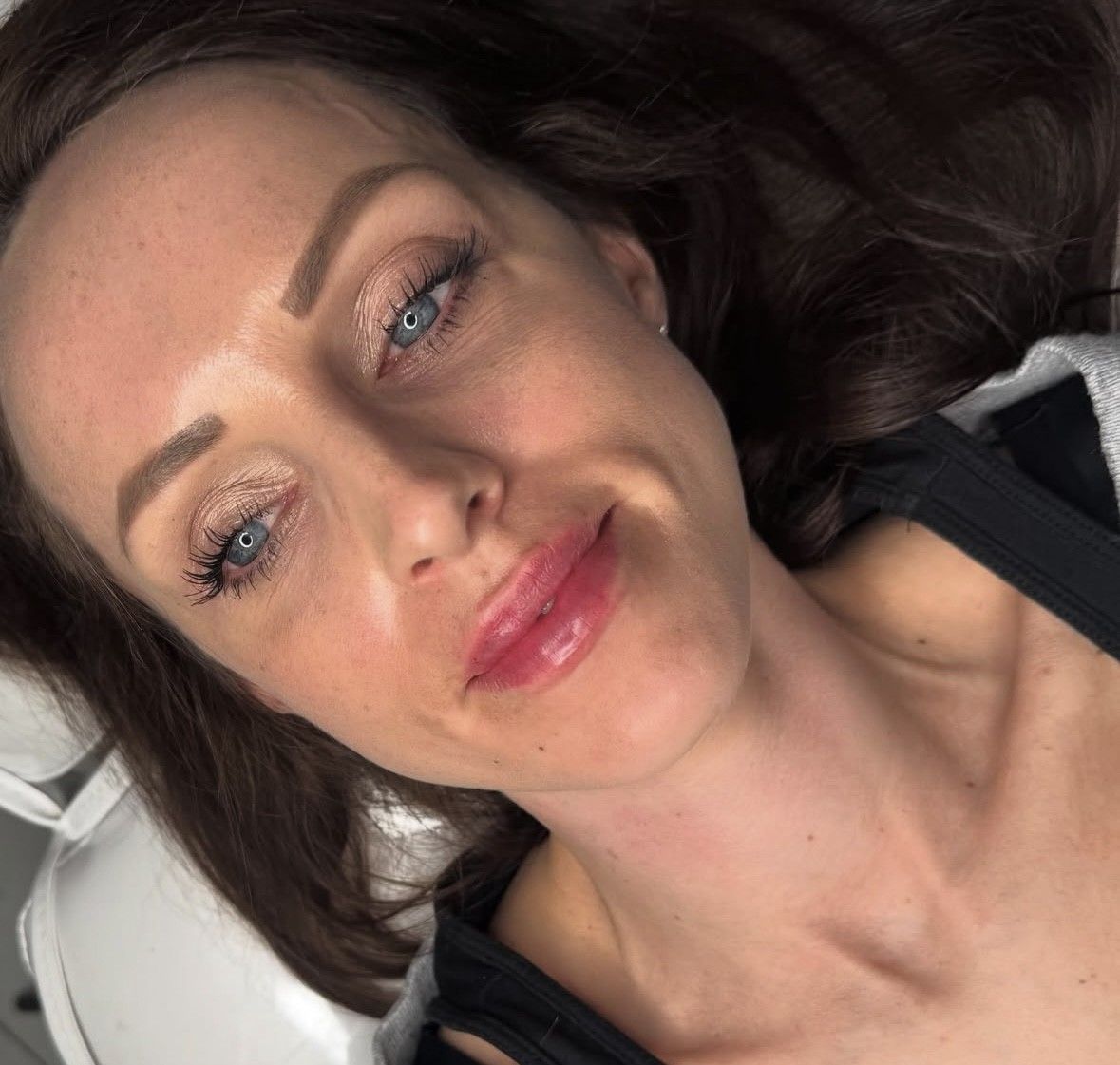 lip filler
