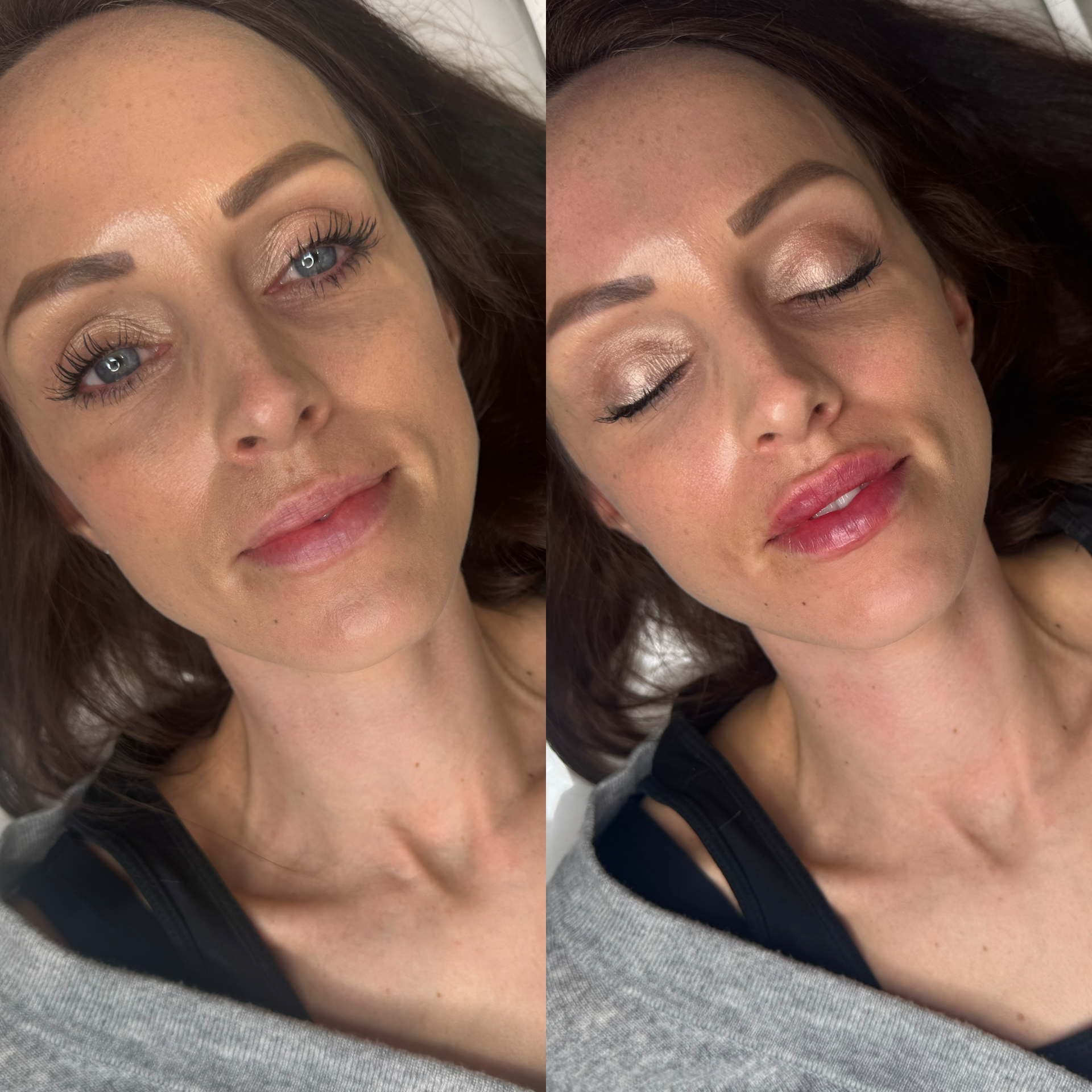 brunette lip filler before and after
