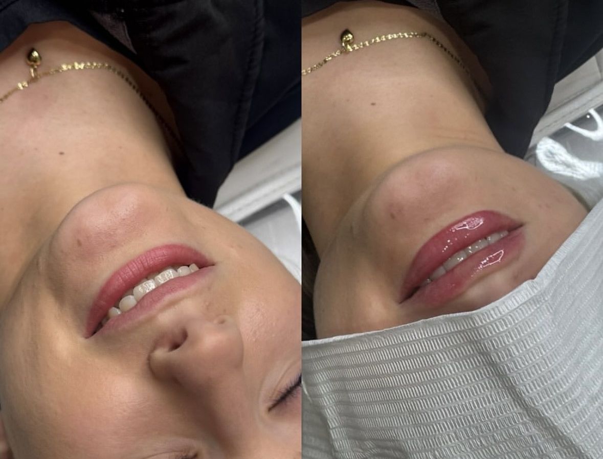 Lip filler before and after