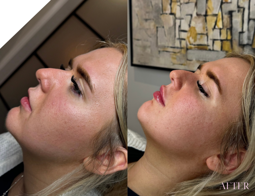 blonde lip filler before and after
