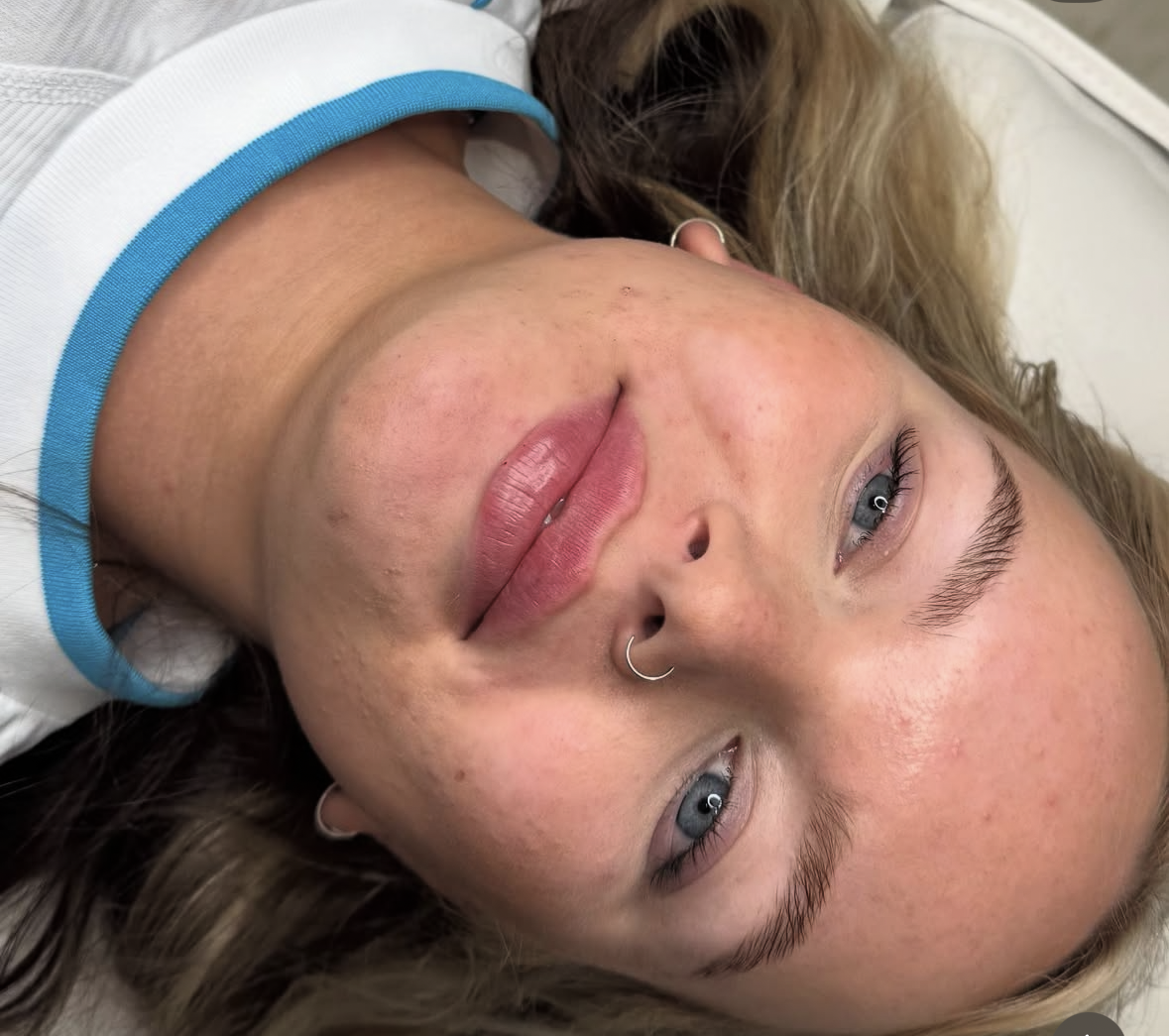 lip filler