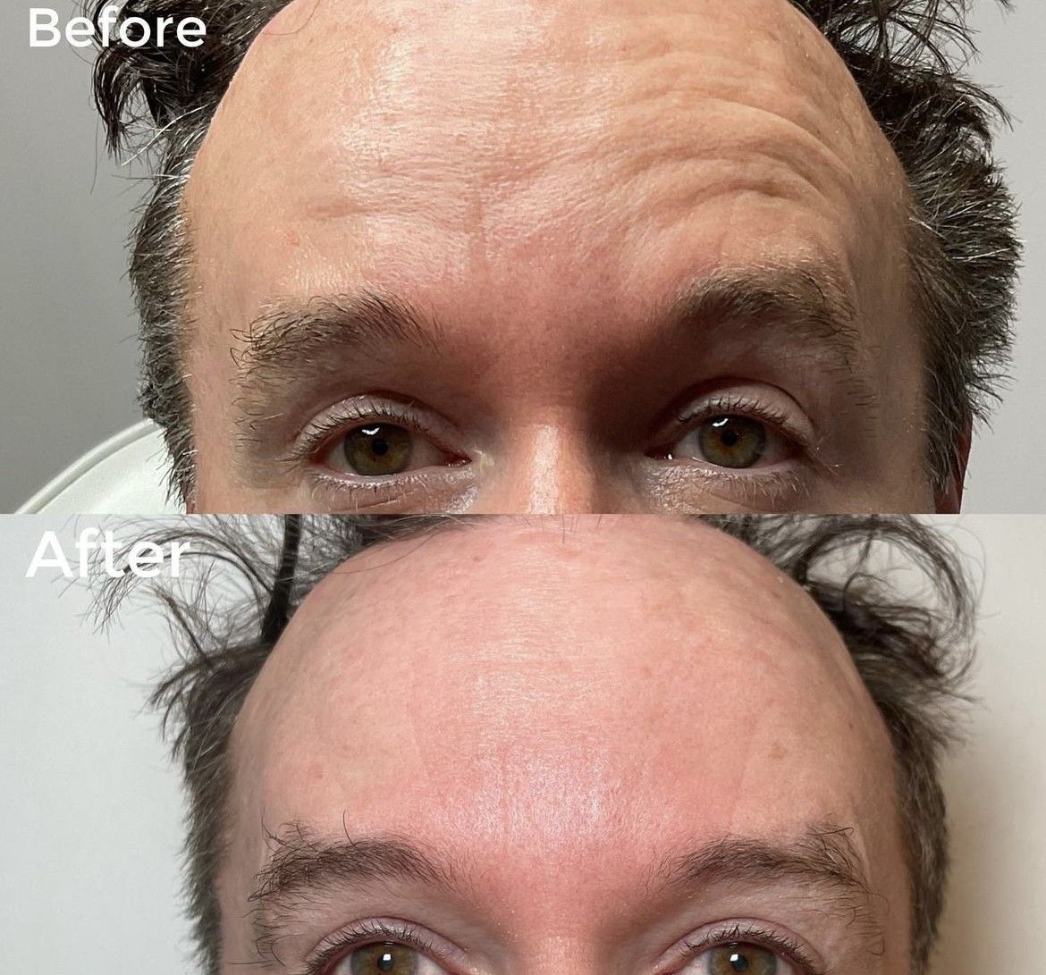 Anti-Wrinkle Treatment