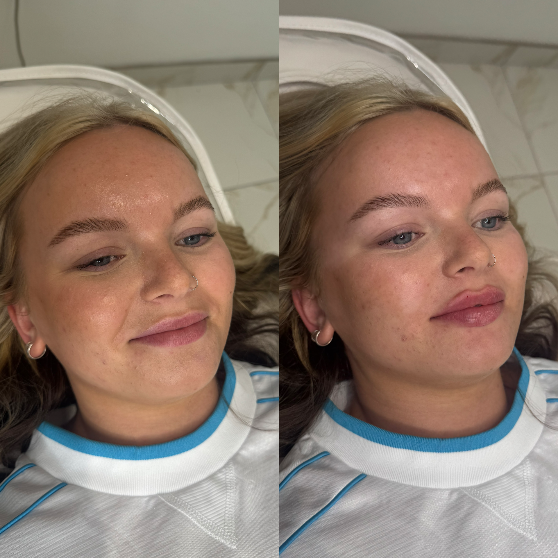 lip filler
