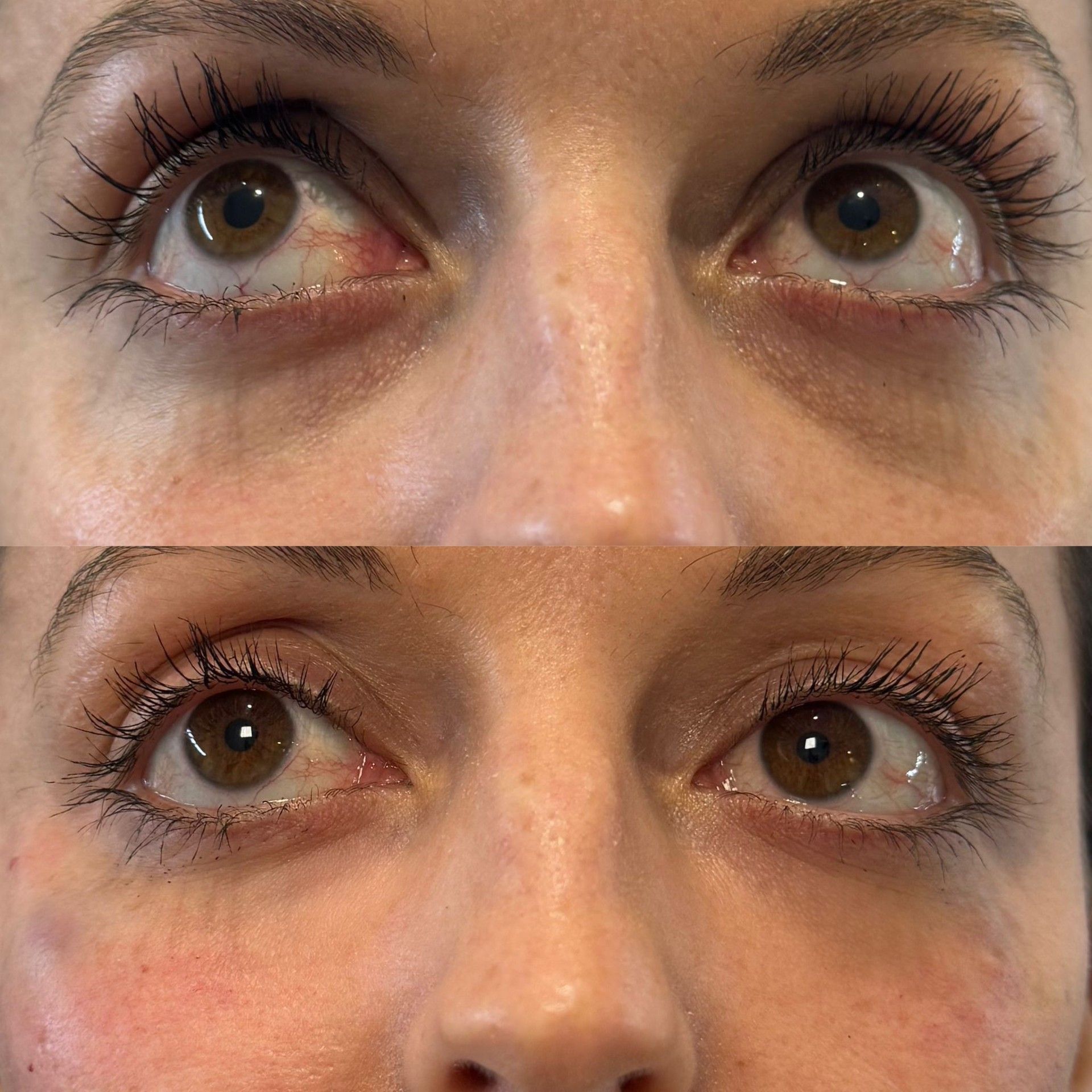 tear trough filler before and after