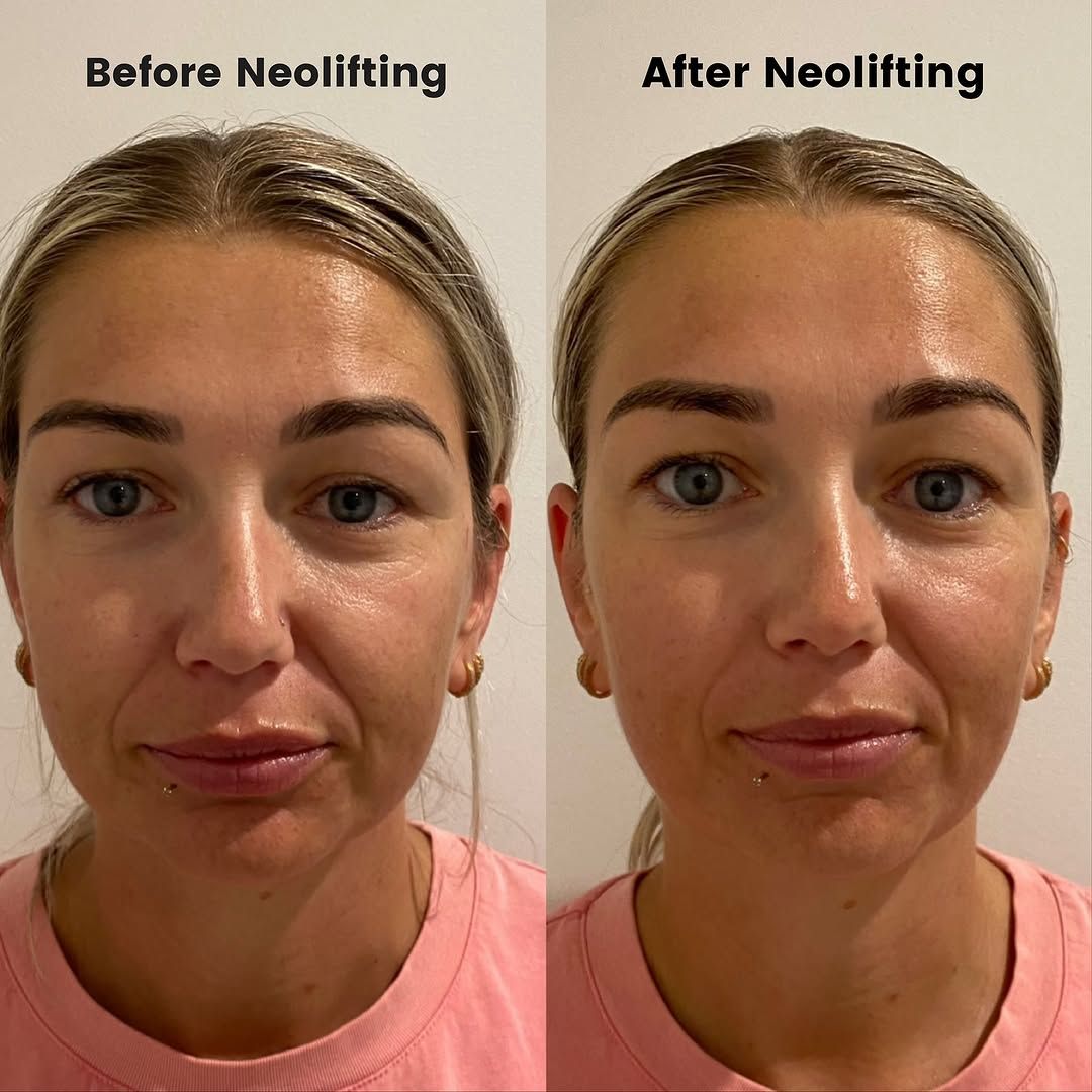Before and after Neolifting buccal massage facial sculpting result