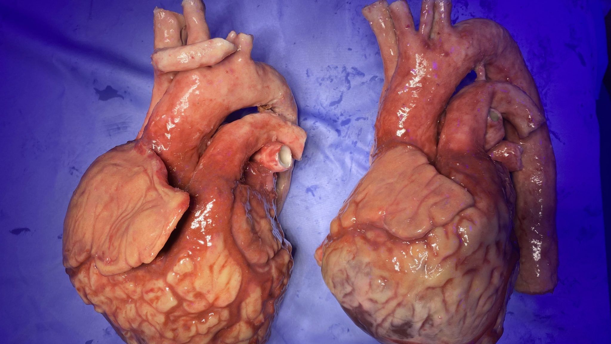 Bioprinting Liability Gap Threatens Hospital Operations, RMIT Research Warns